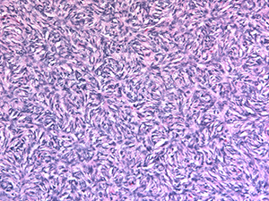 Dermatofibrosarcoma protuberans DFSP