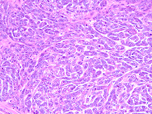 Epithelioid malignant peripheral nerve sheath tumor - soft tissue