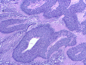 Ewing sarcoma - bone