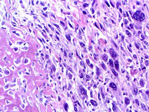 Extraskeletal osteosarcoma - bone