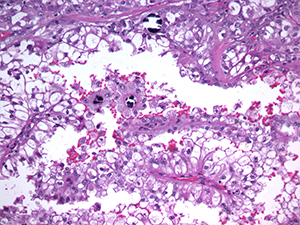 Genitourinary pathology slide