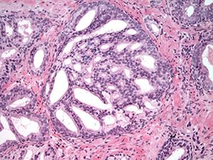 Genitourinary pathology slide