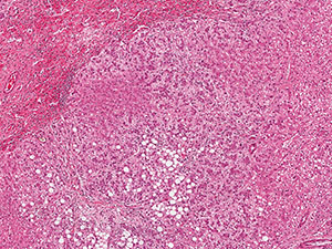 Liver adenoma