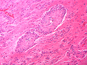 Neuropathology slide image