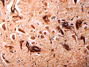 Neuropathology slide image