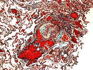 Plexigenic lesion going to vasodilation