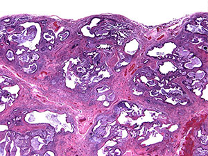 Usual interstitial pneumonia